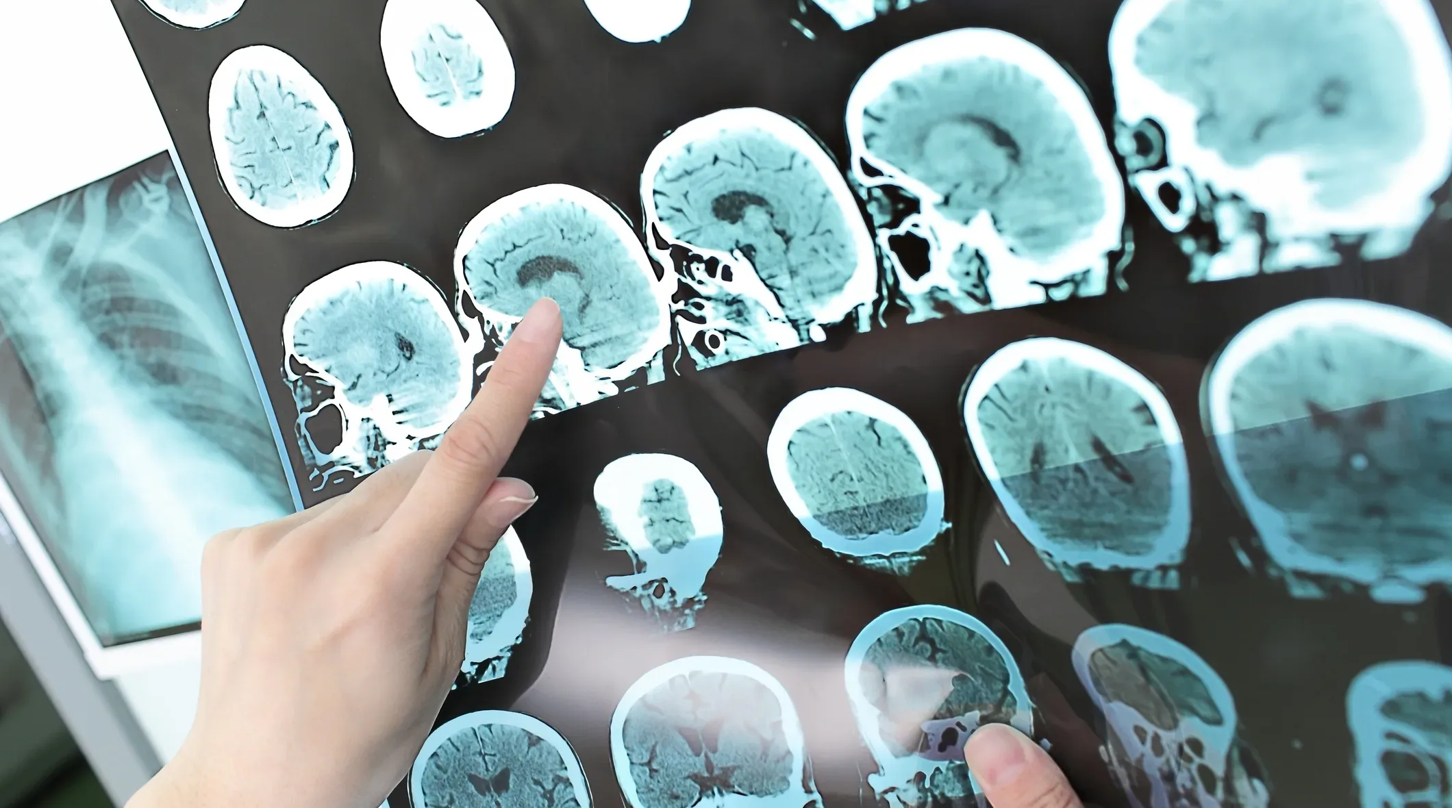Doctor reviewing brain scans on a lightboard, symbolizing Takeda’s push for personalised medicine, telemedicine, and faster rare disease diagnostics in Serbia and the Balkans.